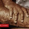 «La Viruela del Mono»: presente en 5 países y encendiendo alarmas, esto es lo que debes saber sobre ella