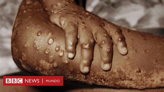 «La Viruela del Mono»: presente en 5 países y encendiendo alarmas, esto es lo que debes saber sobre ella